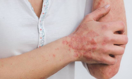 সোরিয়াসিস কি শুধু ত্বকের রোগ? সত্যটা জেনে নিন এখনই