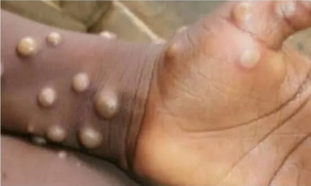 এমপক্সে প্রথম মৃত্যু, আক্রান্ত কত?