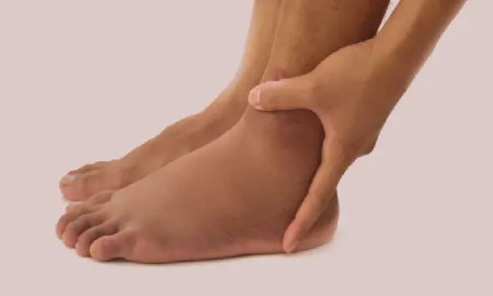 দীর্ঘক্ষণ বসে থাকলেই পা ফুলে যাচ্ছে? এডিমা থেকে রক্ষা পেতে যা করবেন 