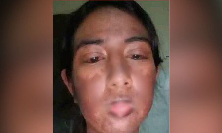 দাঁতের ব্যথা নিয়ে ডাক্তারের কাছে সাদিয়া, ওষুধের প্রতিক্রিয়ায় ‘স্টিভেন জনসন সিনড্রোম’, অতঃপর...