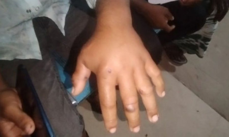 গাইবান্ধায় ১১ জনের শরীরে অ্যানথ্রাক্সের উপসর্গ