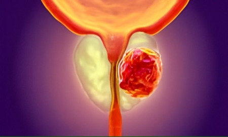 প্রস্টেট ক্যান্সারে মৃত্যুর ঝুঁকি ৪০ শতাংশ কমবে, আশা জাগাচ্ছে দু’টি নতুন ওষুধ