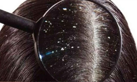 শীত আসতেই ভোগাচ্ছে খুশকি, করণীয় কী?