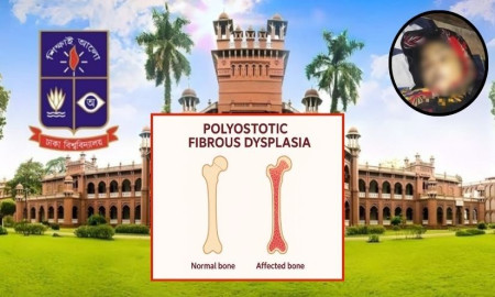 বিরল রোগ ফাইব্রাস ডিসপ্লেশিয়ার যন্ত্রণা সইতে না পেরেই কি ঢাবি ছাত্রী সুমির ‘আত্মহত্যা’?