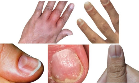 নখের যেসব ছোট ছোট পরিবর্তন বড় রোগের সতর্ক সংকেত!