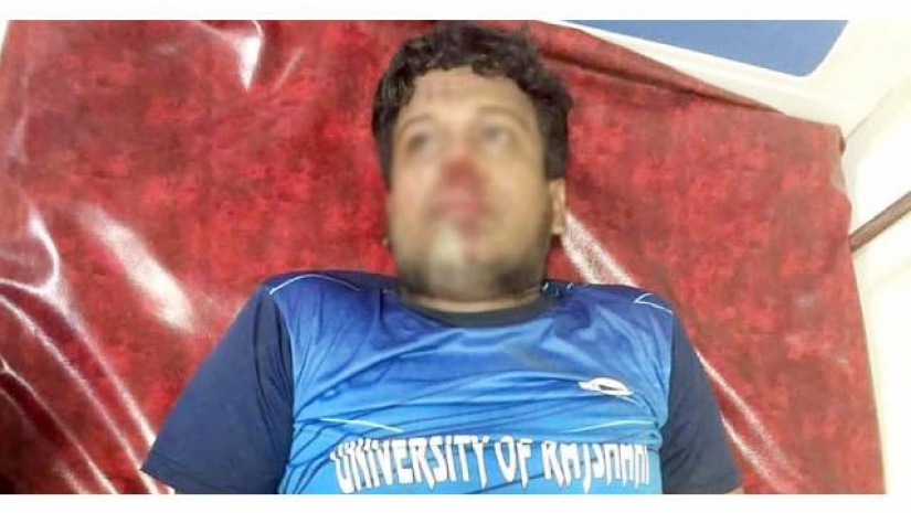 গাছে আম পাড়তে উঠে পড়ে গিয়ে নাক ফাটলো রাবি ছাত্রের