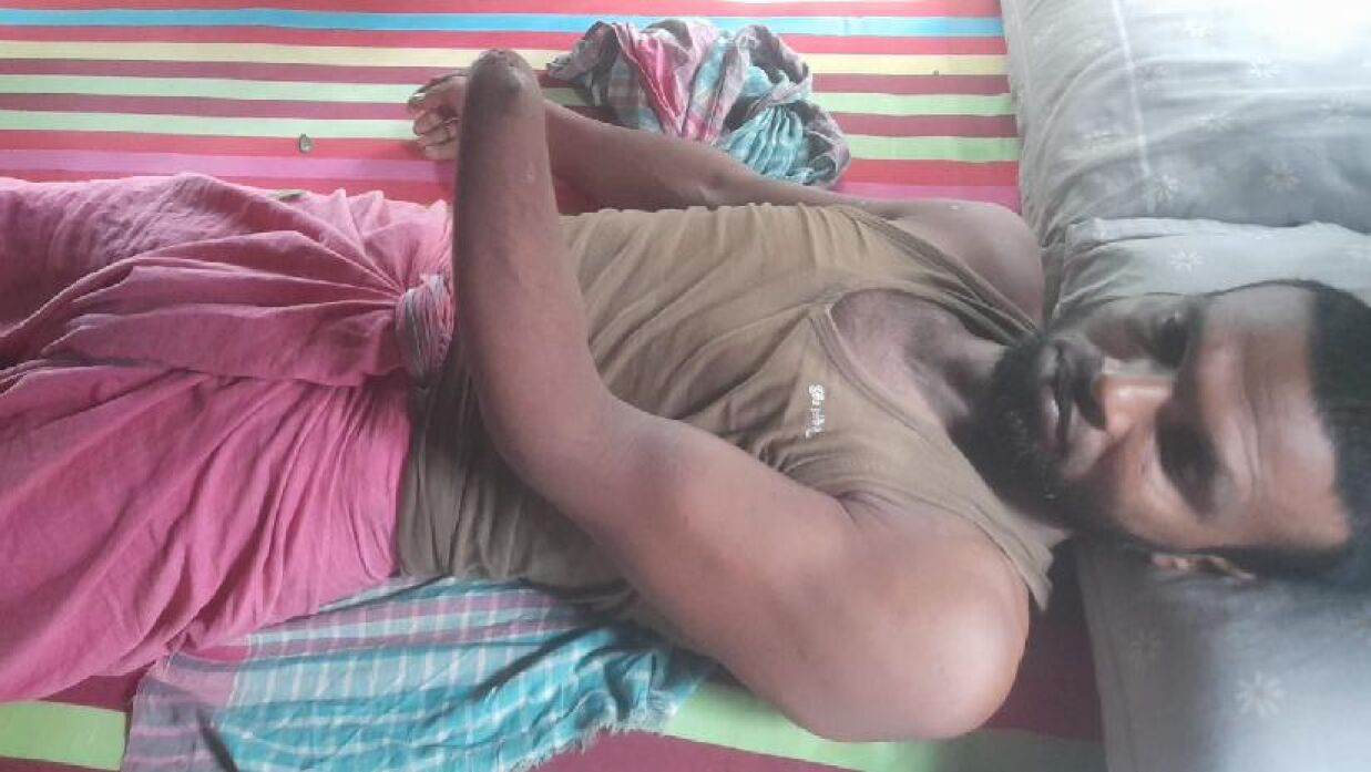 পুলিশের ছোড়া ককটেল বিষ্ফোরনে হাত হারালেন নুর হোসেন