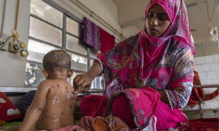 3 More Die with Measles Symptoms in Bangladesh, Death Toll Reaches 840