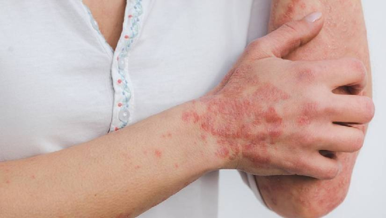 সোরিয়াসিস