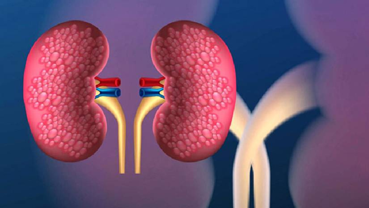 কিডনি রোগ
