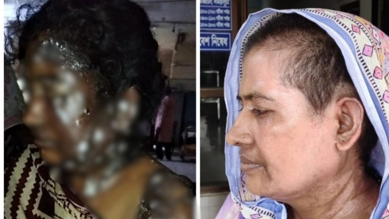 ঝলসে যাওয়া শাহানাজ