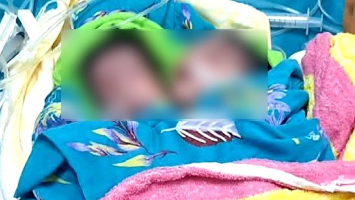 দুটি মাথা নিয়ে জন্ম নেওয়া শিশু