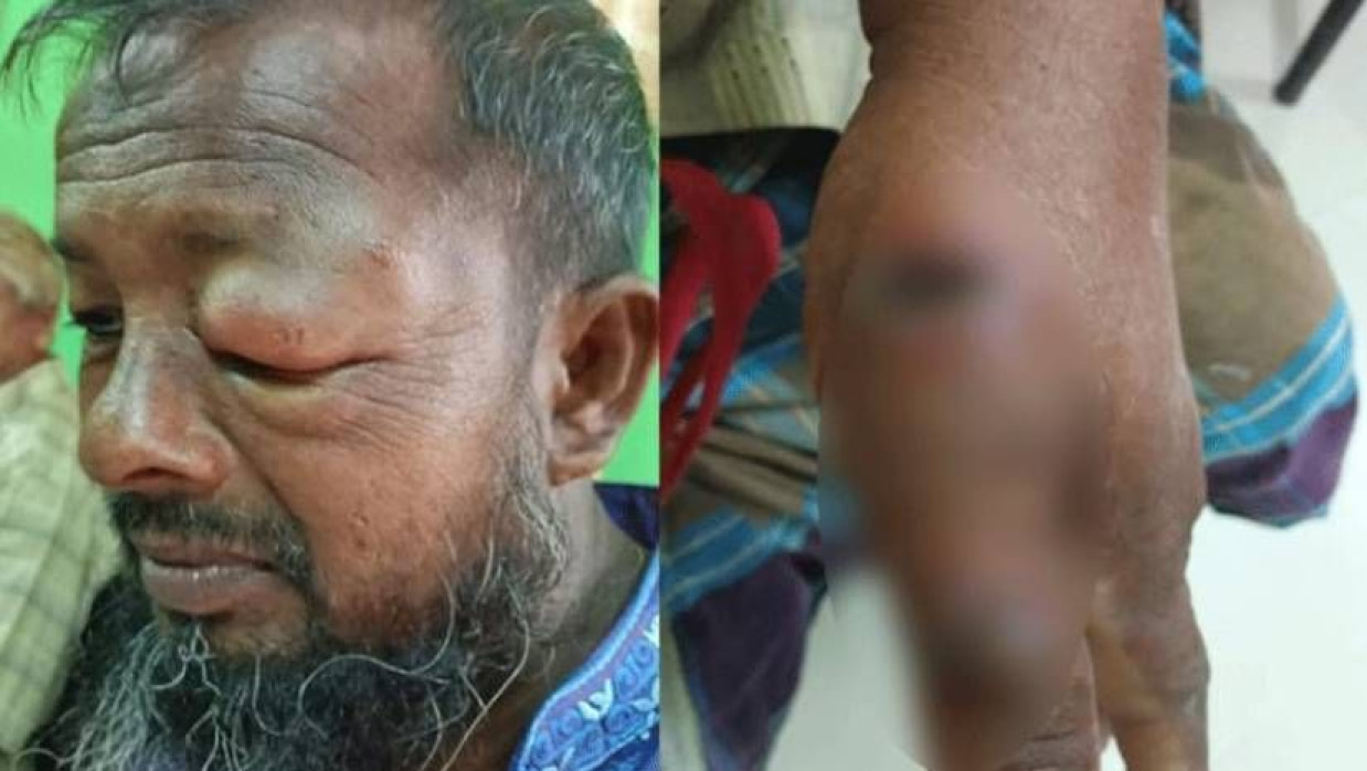 অ্যানথ্রাক্সে আক্রান্ত ব্যক্তি