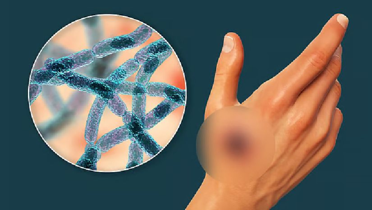 অ্যানথ্রাক্স ব্যাকটেরিয়া