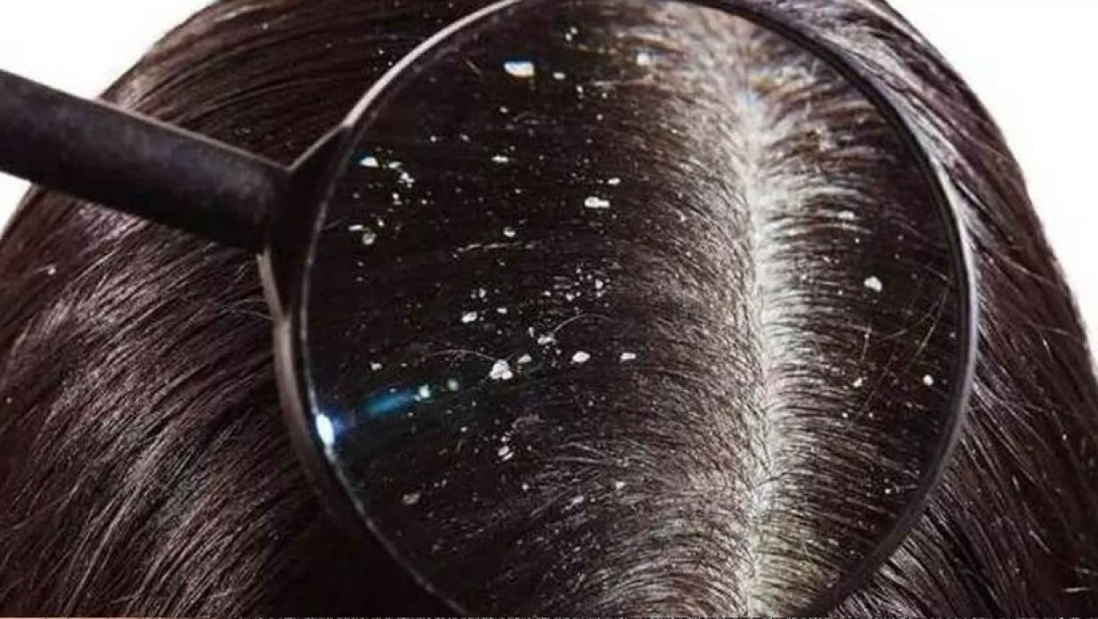 শীত আসার আগে অনেকের মাথায় খুশকির সমস্যা দেখা দিচ্ছে