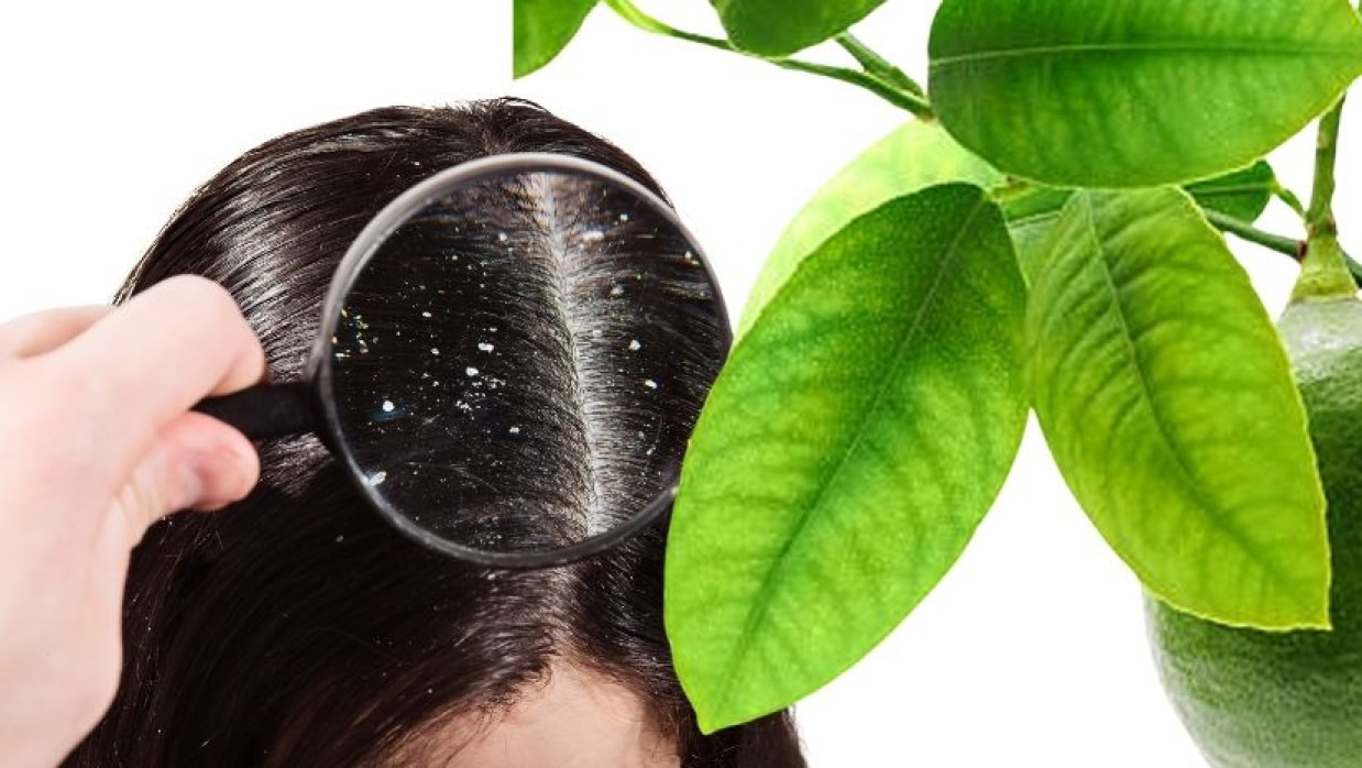 খুশকির সমস্যা 