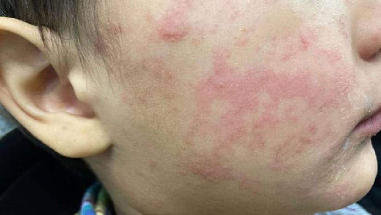 হামের প্রাদুর্ভাব, কক্সবাজারে এক মাসে শতাধিক শিশু হাসপাতালে ভর্তি