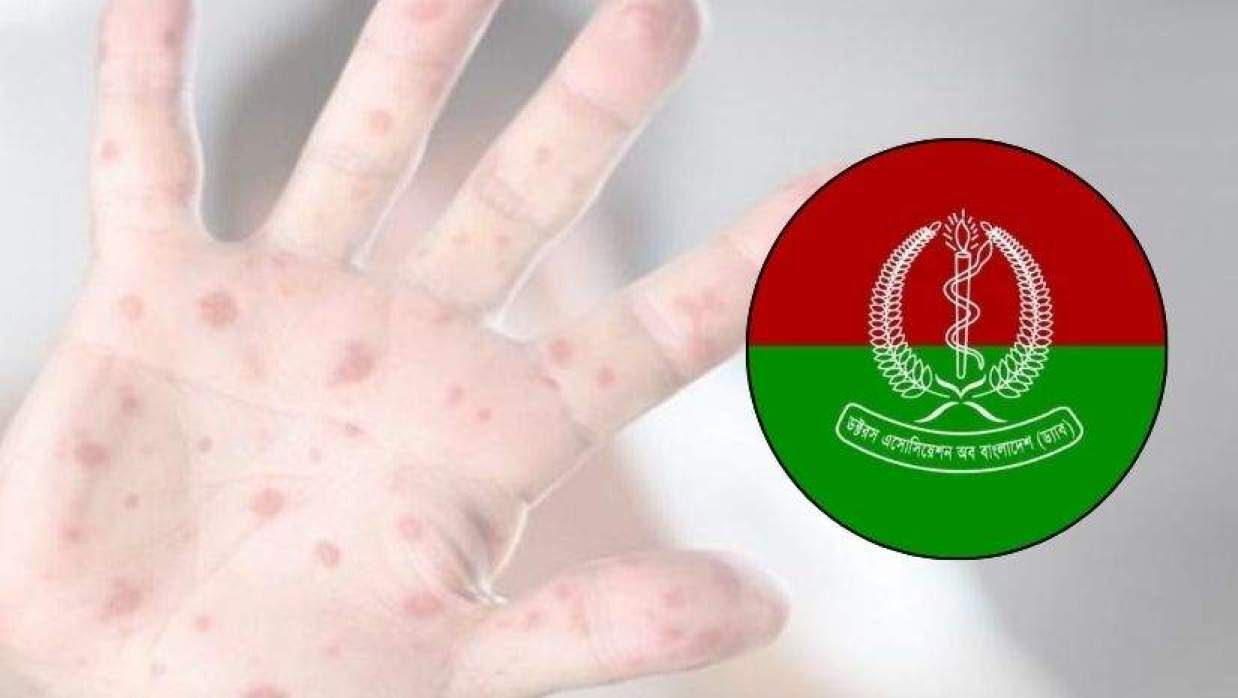 হামের প্রাদুর্ভাব: জরুরি টিকাদান কর্মসূচিতে অংশ নিতে দেশবাসীর প্রতি আহ্বান ড্যাবের