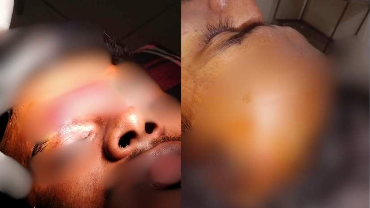 রাতভর সংঘর্ষের ঘটনায় আহত শিক্ষার্থী