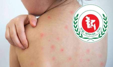 হাম ও হামের উপসর্গে এক দিনে ৮ শিশুর মৃত্যু
