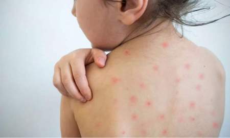 হাম ও হামের উপসর্গে ঝরল আরও ৯ শিশুর প্রাণ