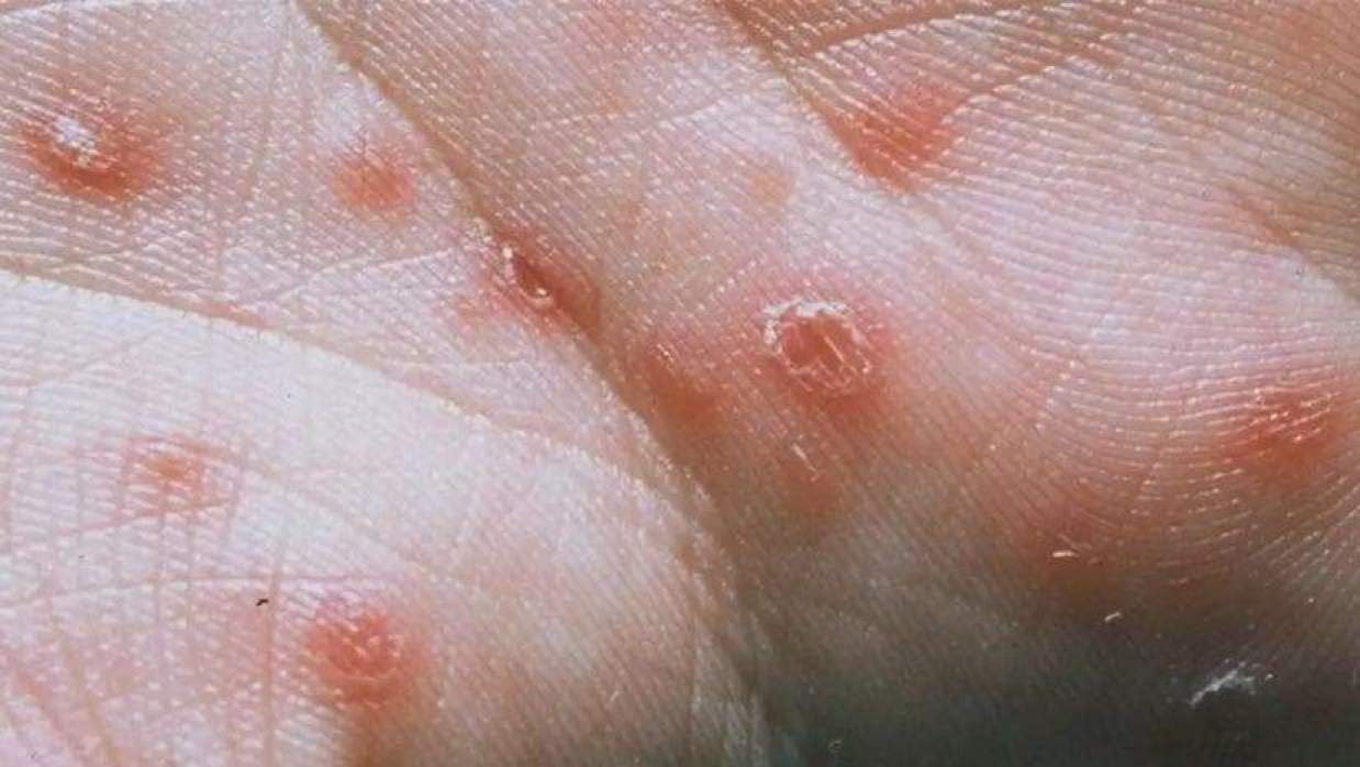 সিফিলিস রোগ