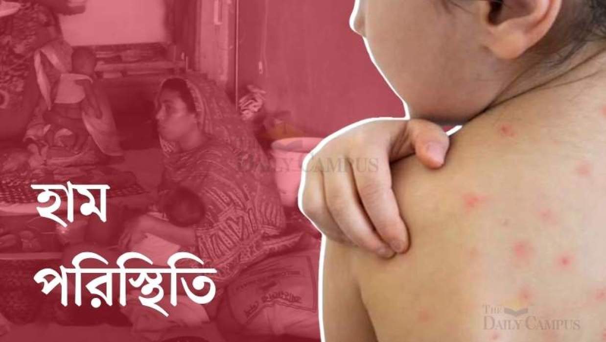 গত ১৫ মার্চ থেকে এ পর্যন্ত হাজারের বেশি শিশু হামে আক্রান্ত হয়েছে, মারা গেছে ৪৫১ জন