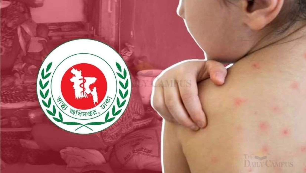 সব হাসপাতালে হামের আলাদা ওয়ার্ড গঠনের নির্দেশ দিয়েছে স্বাস্থ্য অধিদপ্তর