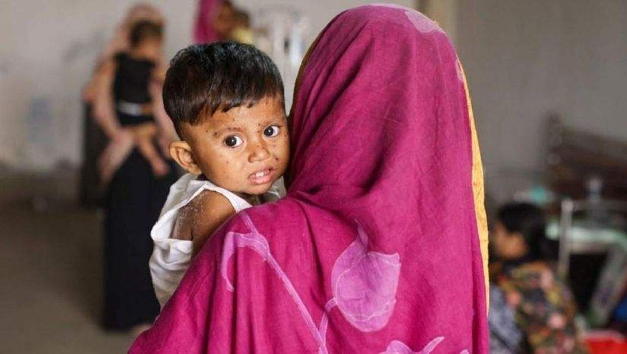 হাম ও এর উপসর্গে গত ২৪ ঘণ্টায় আরও ৮ শিশুর মৃত্যু হয়েছে