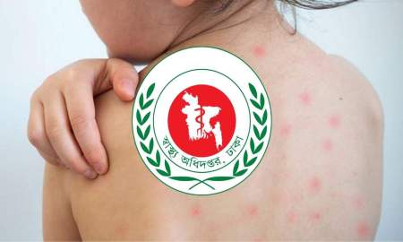 হামের থাবায় আরও ৭ শিশুর মৃত্যু, দুই মাসে প্রাণ হারাল ৪৩৯