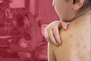 হামে আরও ৫ শিশুর প্রাণহানি