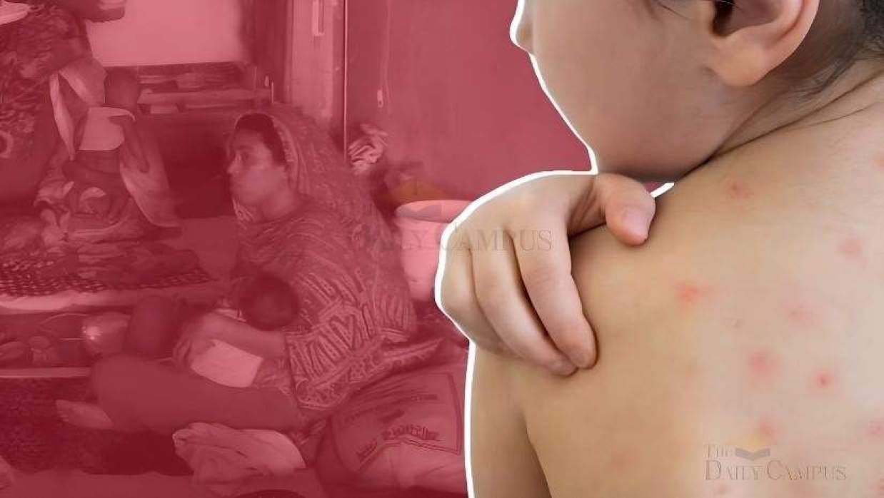 হামে আরও ৫ শিশুর মৃত্যু, তিন মাসে ৬৬৬ জনের প্রাণহানি