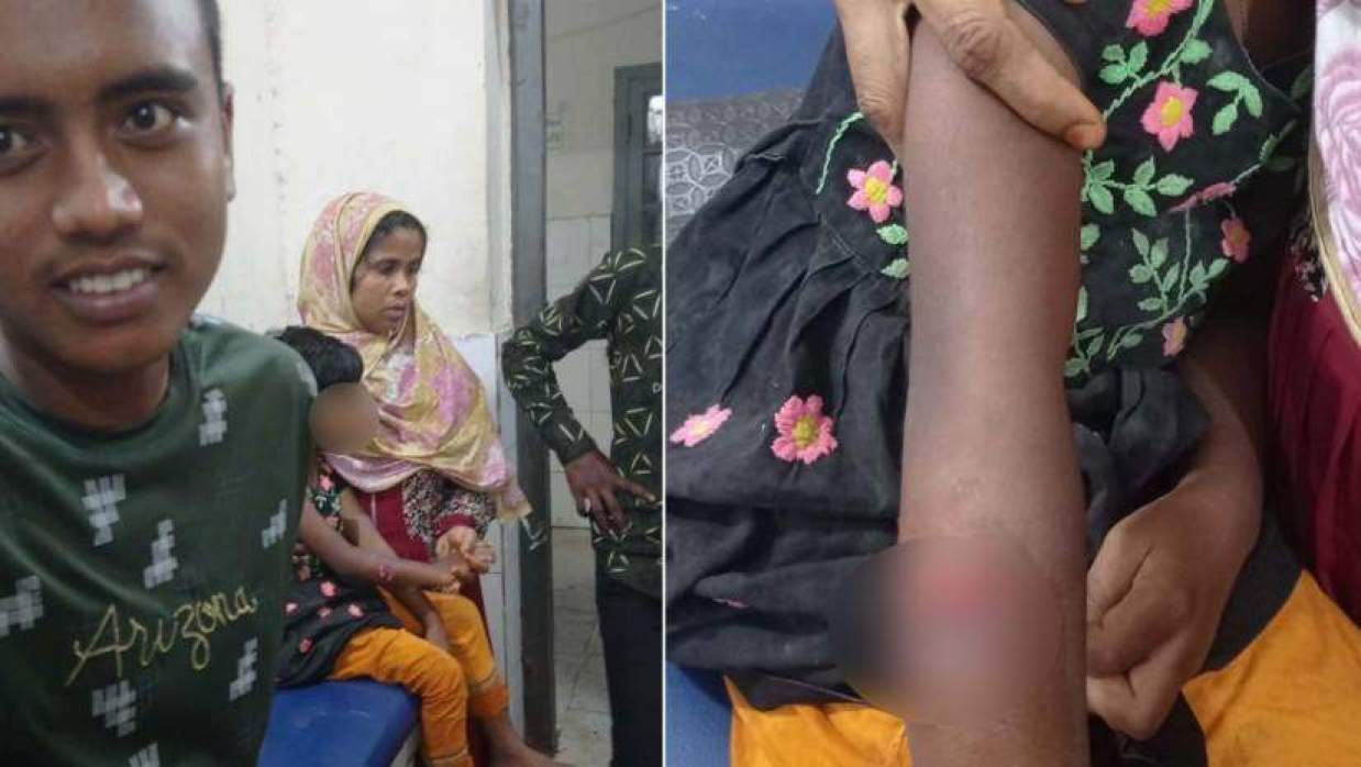 পাগলা কুকুরের কামড়ে এক শিশু চিকিৎসাতে নিয়ে আসে উপজেলা স্বাস্থ্য কমপ্লেক্সে