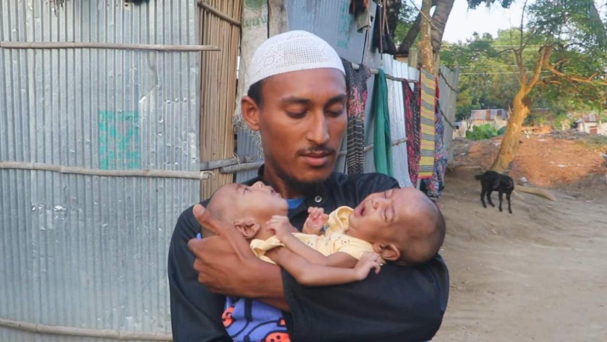 বাঁচানো গেল না পেট জোড়া লাগা সেই দুই জমজ শিশুকে