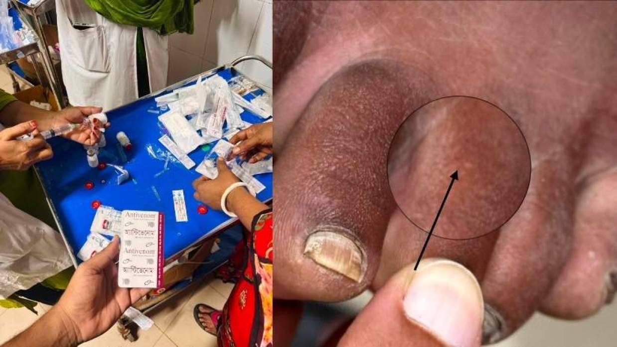সাপে কাটা রোগিকে তাৎক্ষণিক চিকিৎসা 