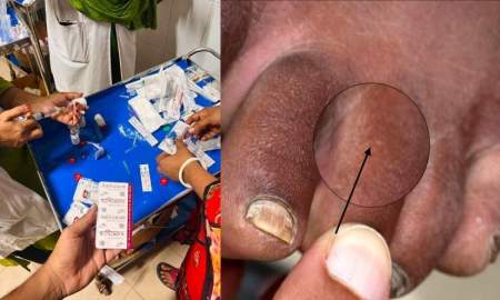 মধ্যরাতে খাট থেকে নামতেই সাপের ছোবল, স্বাস্থ্য কমপ্লেক্সে চিকিৎসকের তৎপরতায় বাঁচল প্রাণ