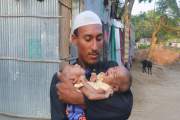 বাঁচানো গেল না পেট জোড়া লাগা সেই দুই জমজ শিশুকে