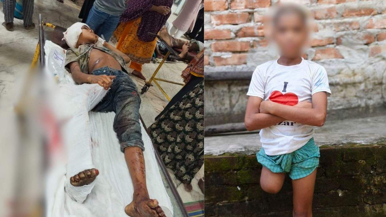 বাঁয়ে গুরুতর আহত শিশুটির হাসপাতালে থাকা ছবি ডানে বাড়ী ফেরার পরের ছবি