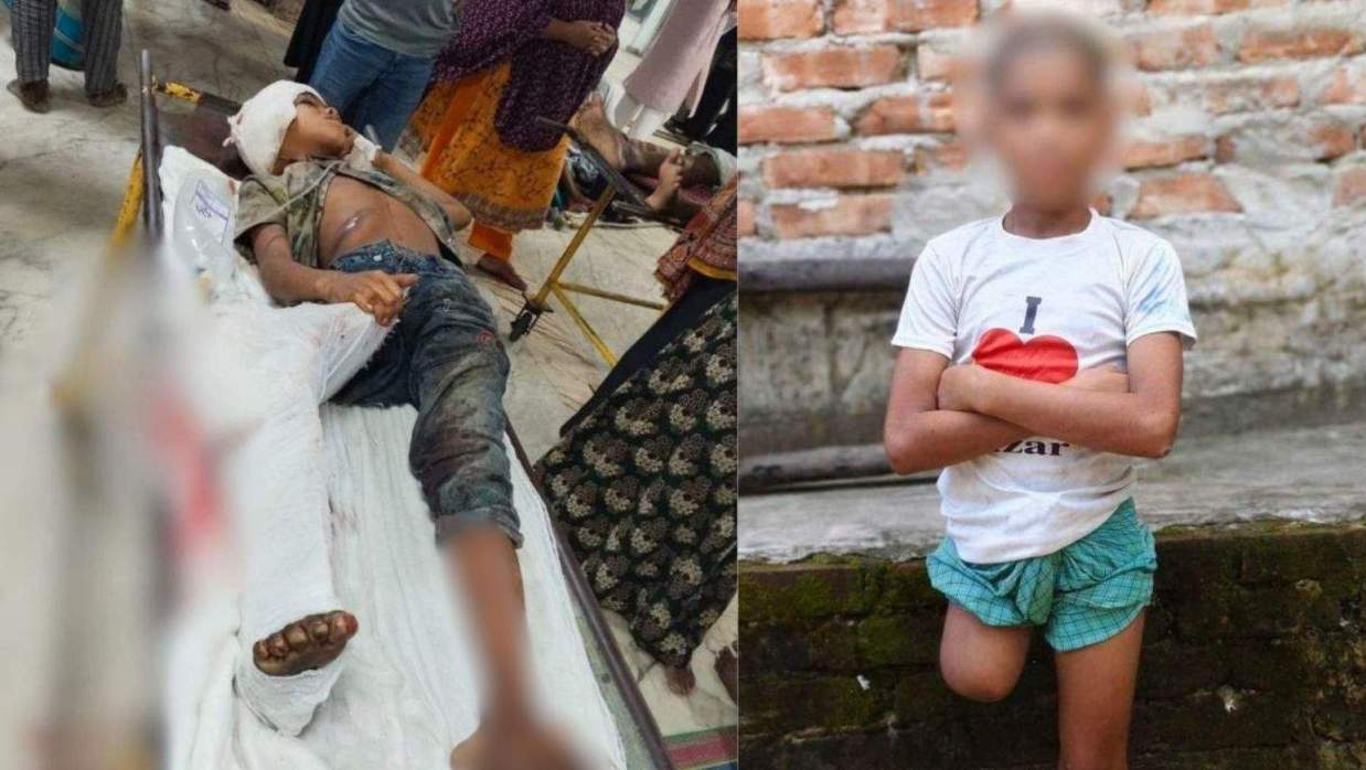 বাঁয়ে গুরুতর আহত শিশুটির হাসপাতালে থাকা ছবি ডানে বাড়ী ফেরার পরের ছবি