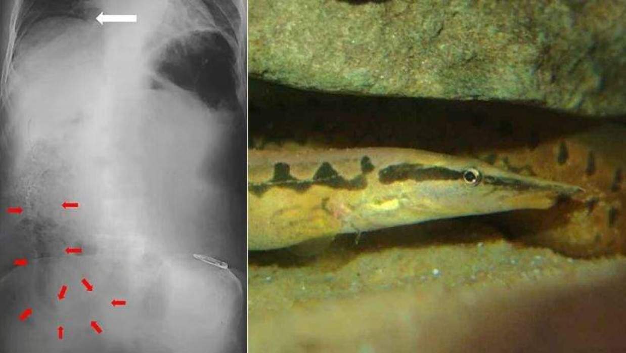 বামে পেটের এক্স–রেতে সন্দেহজনক গ্যাস (সাদা তির) ও বাইম মাছের অস্তিত্ব দেখা যাচ্ছে (লাল তির), ডানে বাইম মাছের ফাইল ছবি