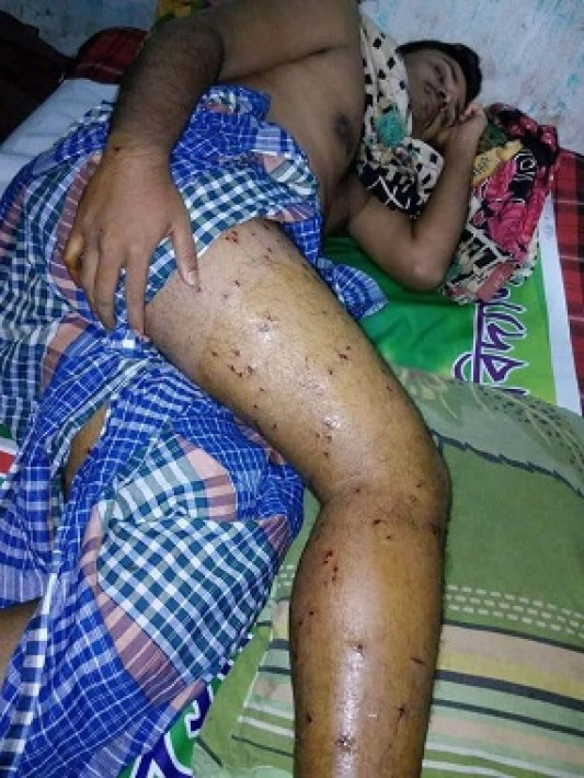 কোটা সংস্কার আন্দোলনে পুলিশের ছোররা গুলিতে আহত রাজীবুল ইসলাম।