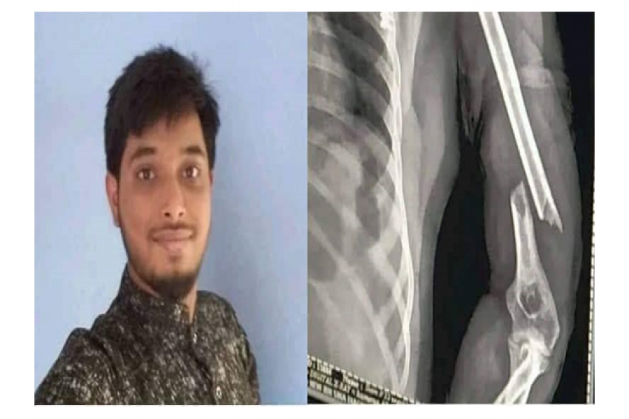 ইজিবাইক উল্টে বশেমুরবিপ্রবি শিক্ষার্থীর হাড় দ্বিখন্ডিত