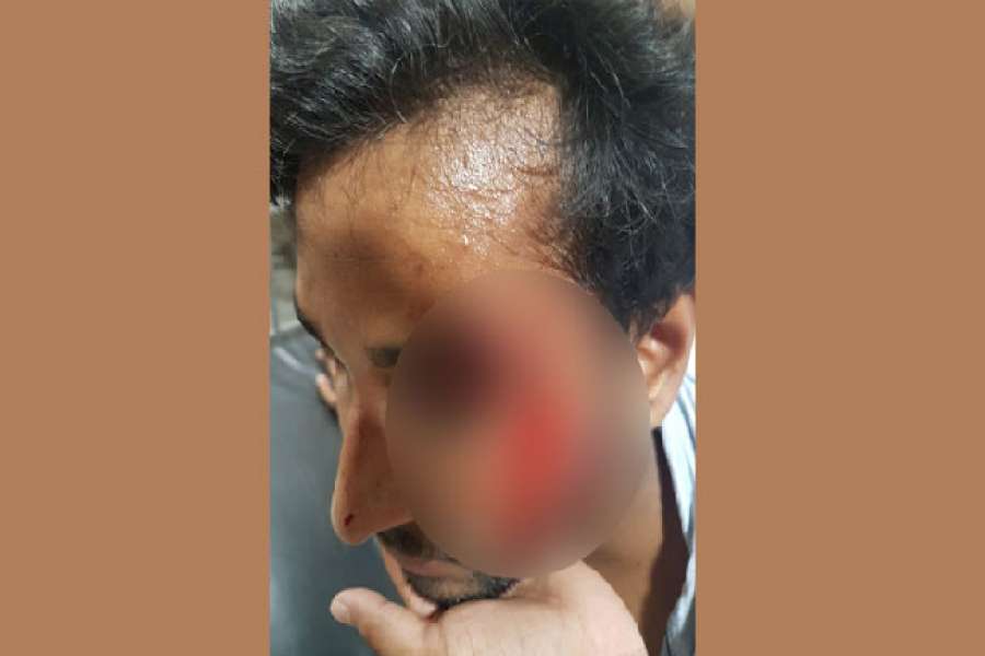 র‌্যাগিংয়ের প্রতিবাদ করায় রাবি শিক্ষার্থীর চোখে আঘাত