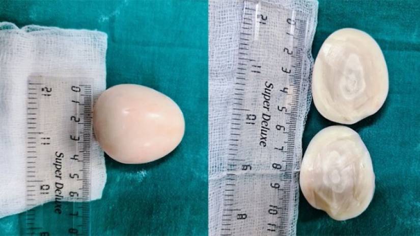 অস্ত্রোপচারের পর রোগীর পেট থেকে বেরোল আস্ত সেদ্ধ ডিম!