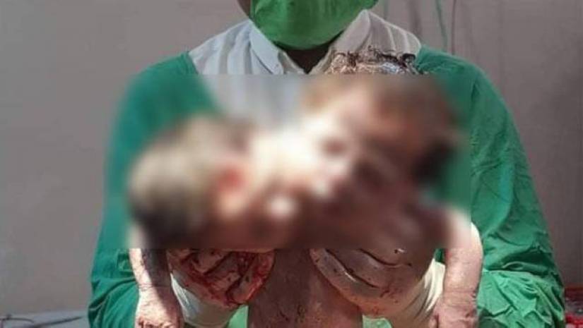 বাঁচানো যায়নি জোড়া মাথার কন্যাশিশুটি