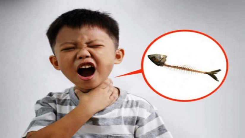 গলায় কাঁটা আটকানোর ছবি 