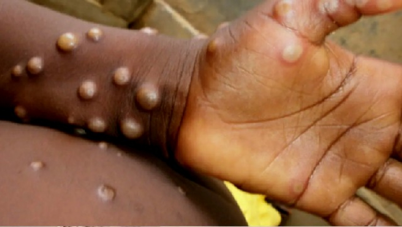 মাঙ্কিপক্স