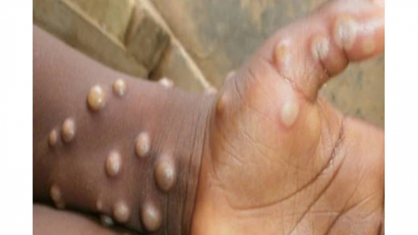 মাঙ্কিপক্স