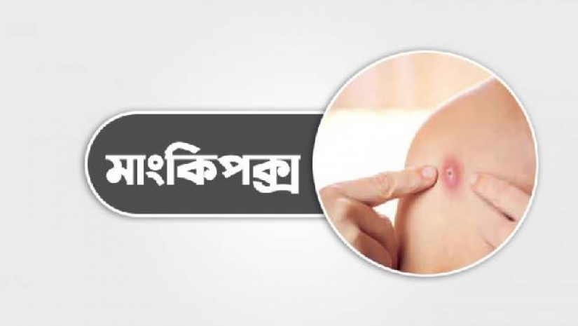 মাঙ্কিপক্স