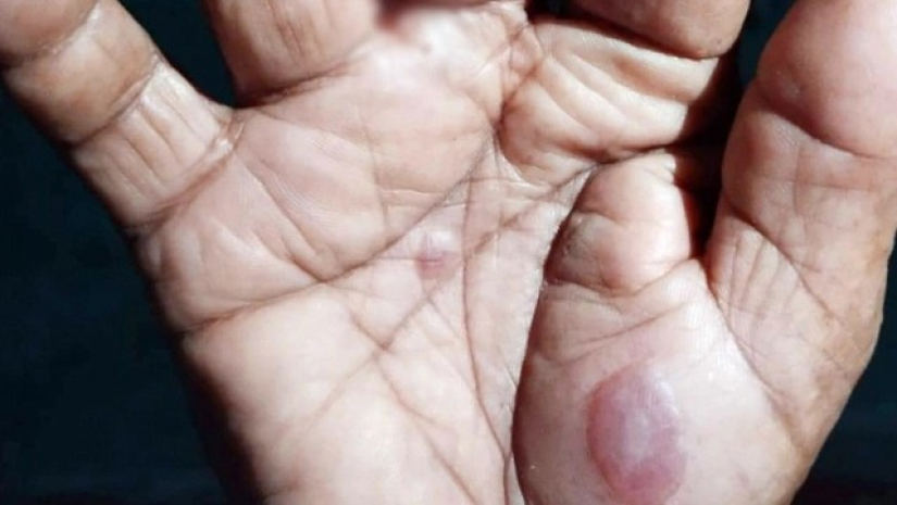 মাঙ্কিপক্স রোগের লক্ষণ